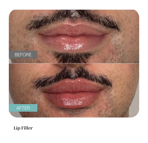 Before and after treatment result — Dr. Lanna, LC Medical Aesthetics NYC